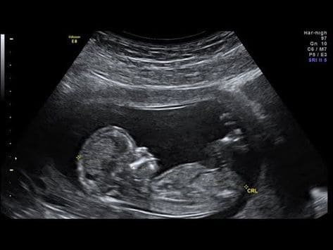 L’échographie du premier trimestre : un moment clé de la grossesse ! 