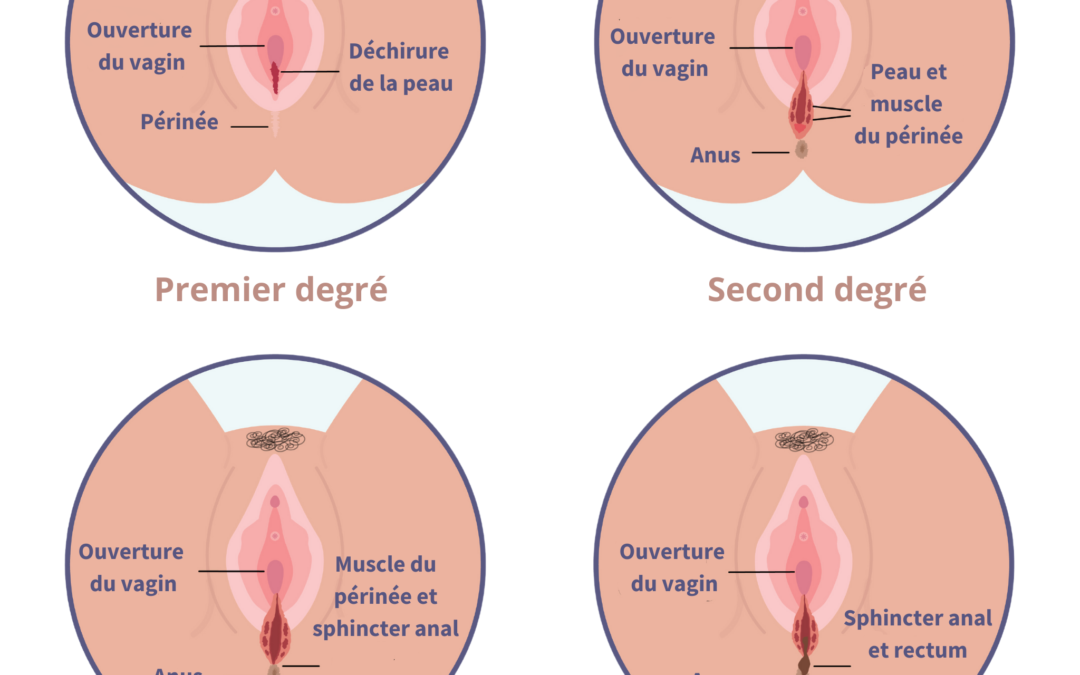 Nos conseils pour éviter les déchirures lors de l’accouchement